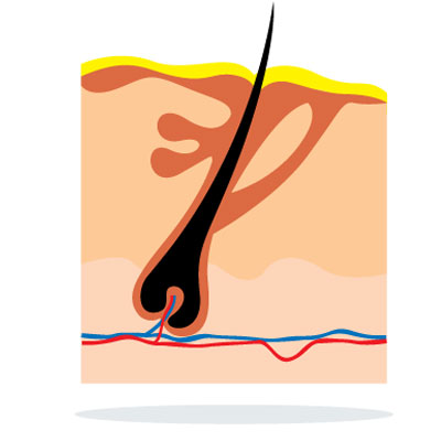 atopic-dermatitis-eczema