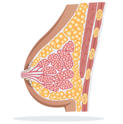 breast-carcinoma-breast-cancer