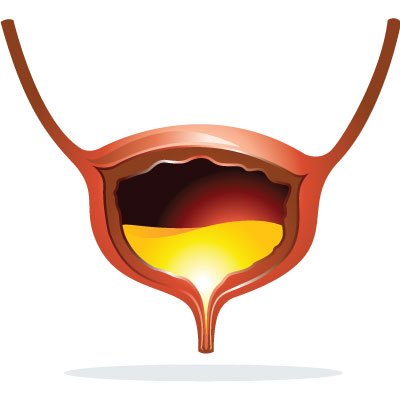 cystitis-urinary-tract-infection-uti