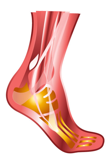 plantar-fascial-fibromatosis-plantar-fasciitis